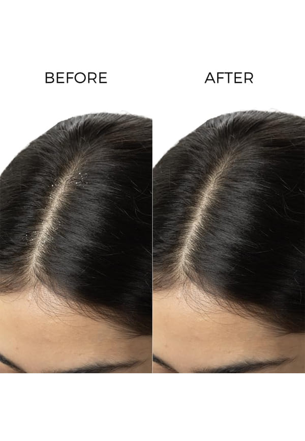 Tea Tree Anti Dandruff Shampoo – thumbnail 4
