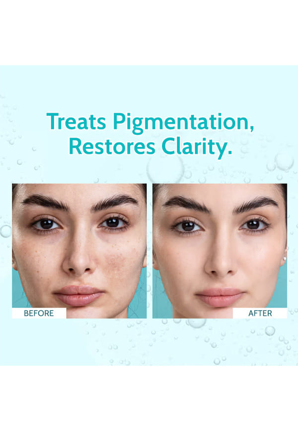 Clarifying Serum, 10% Niacinamide, 3% Tranexamic Acid, For Clear & Spotless Skin – thumbnail 2