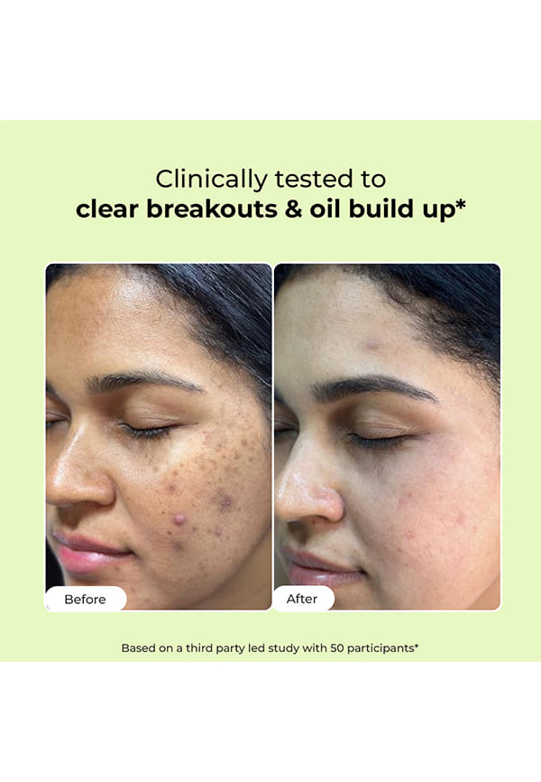 Flashfix Salicylic Acid Cleanser For Oily Acne Prone Skin – thumbnail 2
