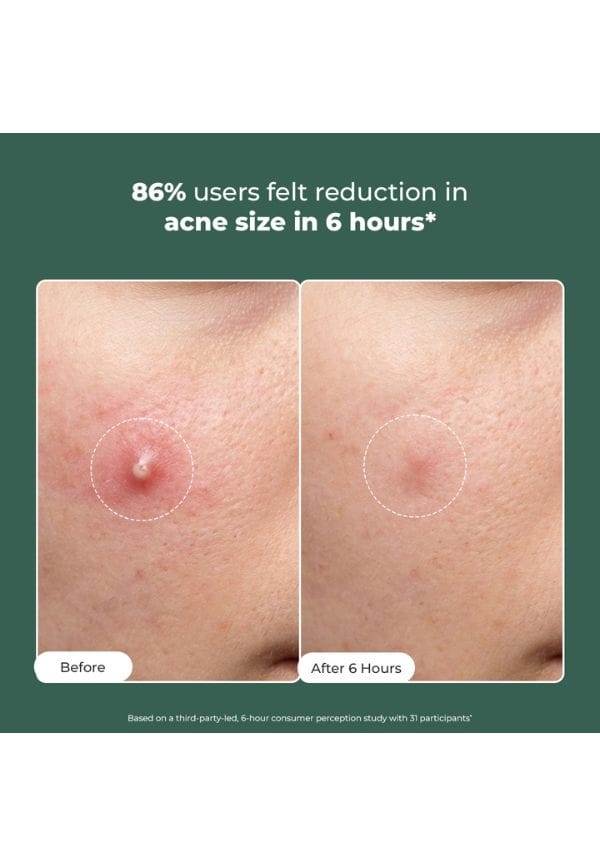 Rapid Relief Acne Spot Corrector Gel – thumbnail 2