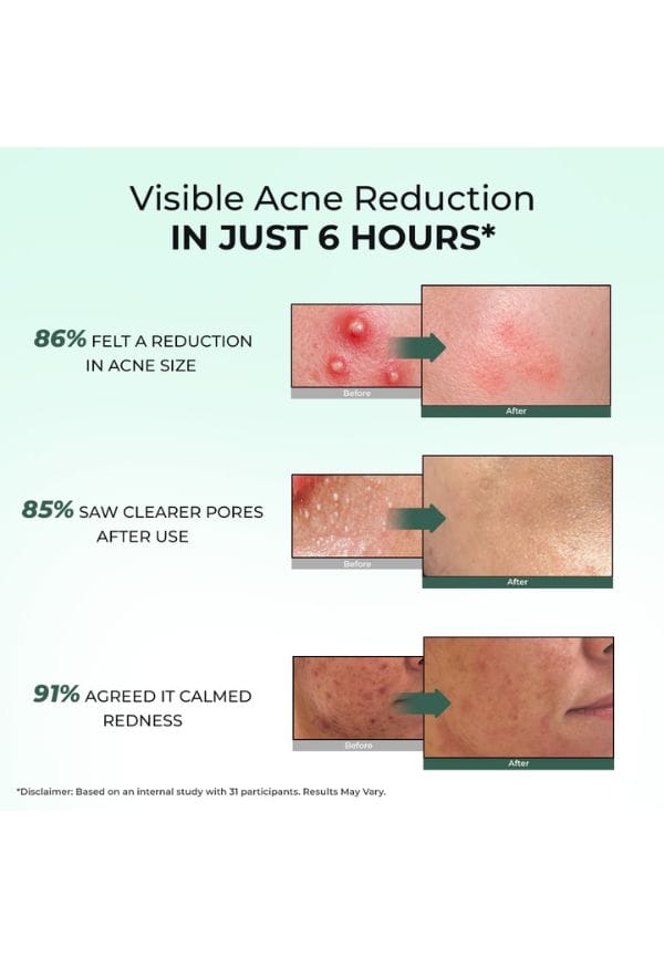 Rapid Relief Acne Spot Corrector Gel – thumbnail 4