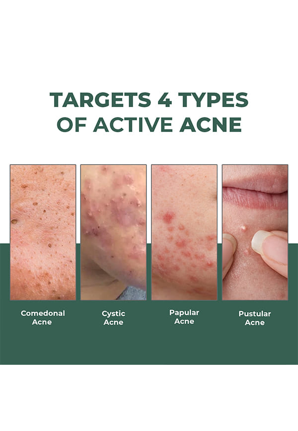 Rapid Relief Acne Spot Corrector Gel – thumbnail 6