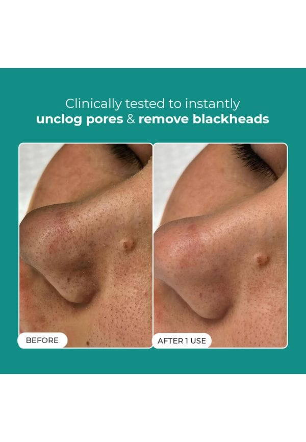 Blackhead Melting Water – thumbnail 2
