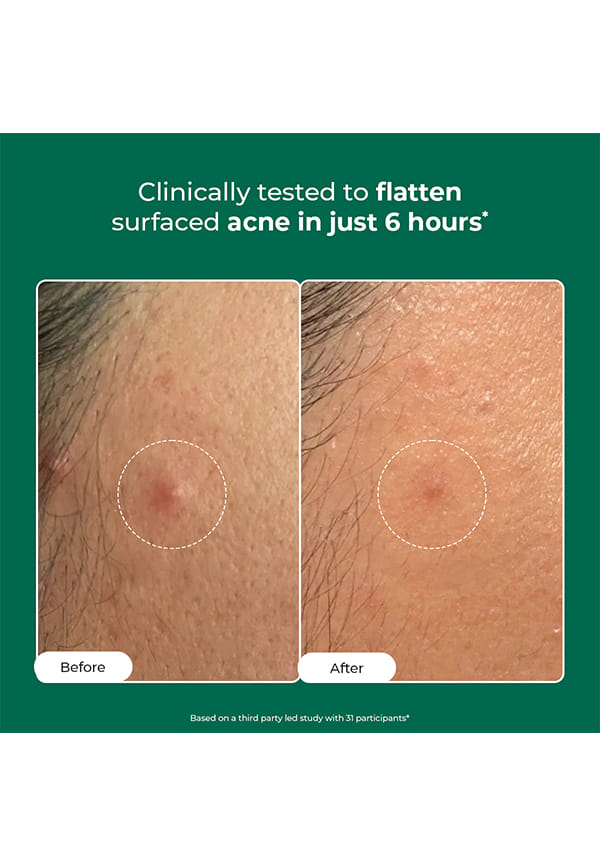 Self Dissolving Acne Clearing Patch – thumbnail 2