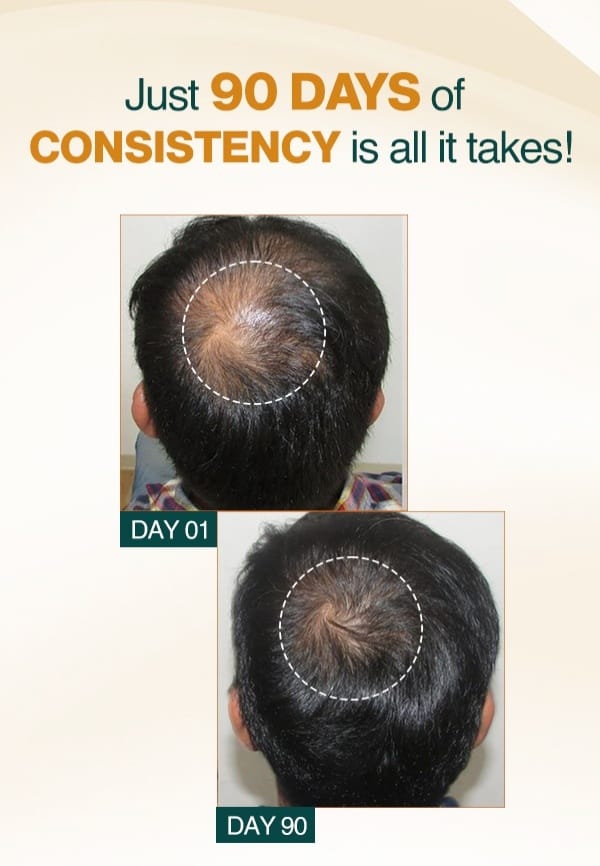 Advanced Hair Growth Serum for Hair Regrowth and Prevention of Hair Thinning - 50 ml – thumbnail 3