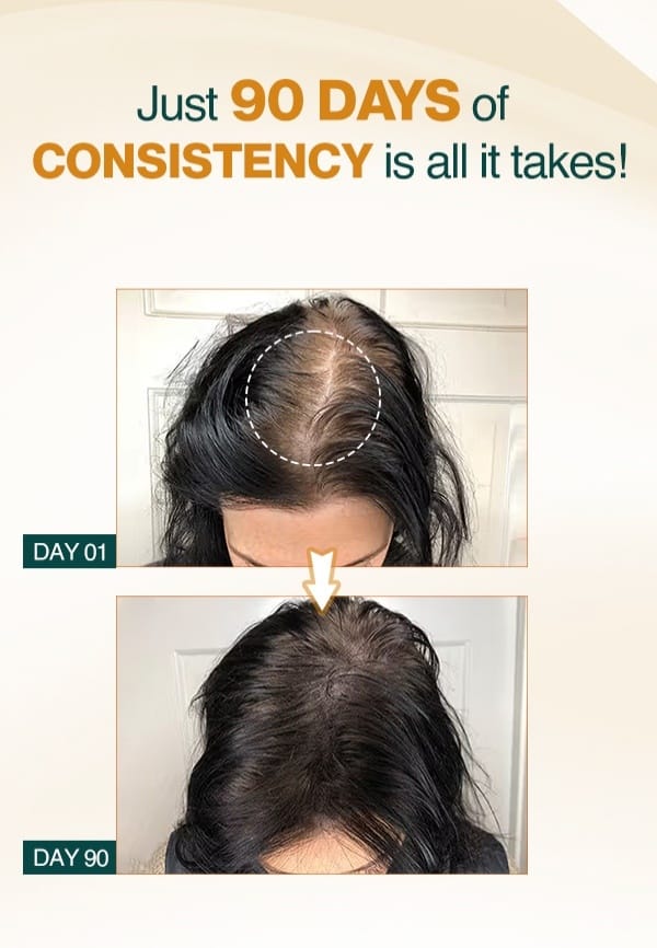 Advanced Hair Growth Serum With Rosemary Oil for Hair Regrowth and Stop Hairfall - 25 ml – thumbnail 2