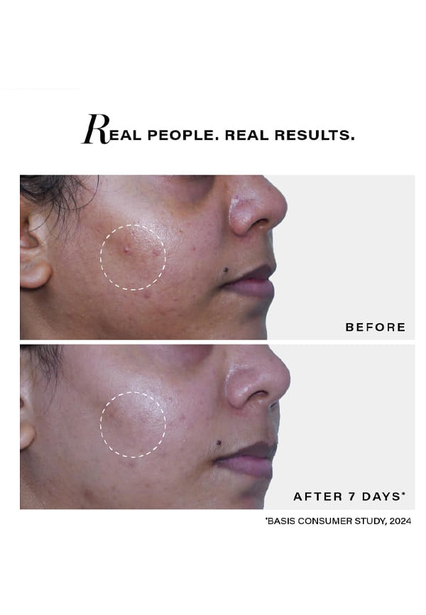 Acne Clearing Face Wash, Face Wash for Acne, Whiteheads, Blackheads – thumbnail 4