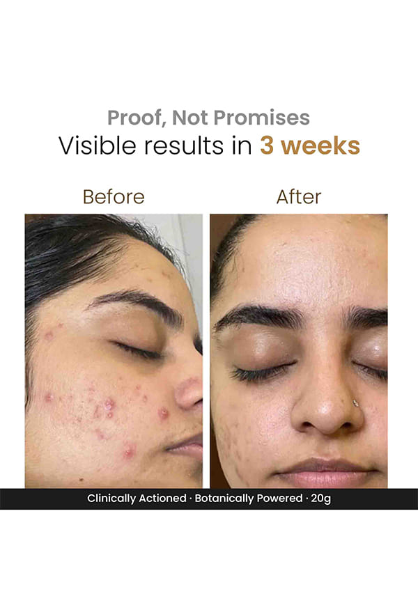 Zitsit Spot Corrector Gel – thumbnail 5