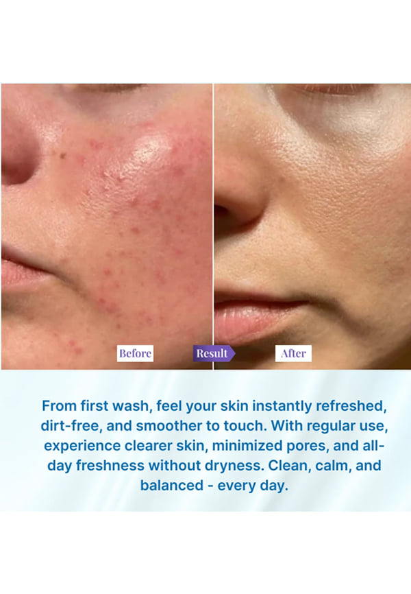 Oily Skin Cleanser – thumbnail 5