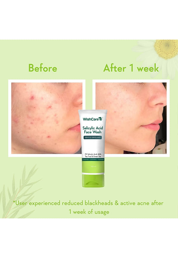2% Salicylic Acid Face Wash – thumbnail 4