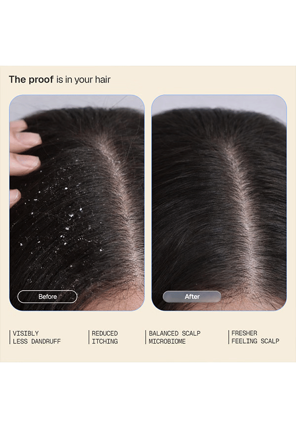 Anti-Dandruff Hair Care Combo – thumbnail 4