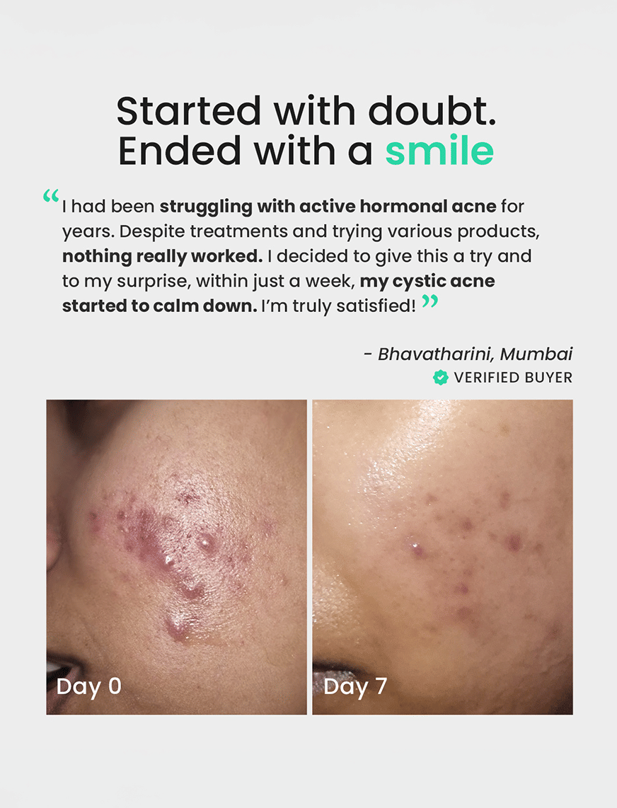 Solved Skin Acne Care Combo Kit – thumbnail 4
