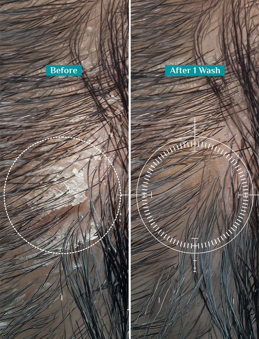 Non-Drying Anti-Dandruff Shampoo – thumbnail 5